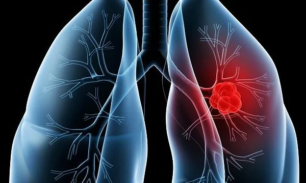 Hạt silica trong khói hàn gây viêm phổi